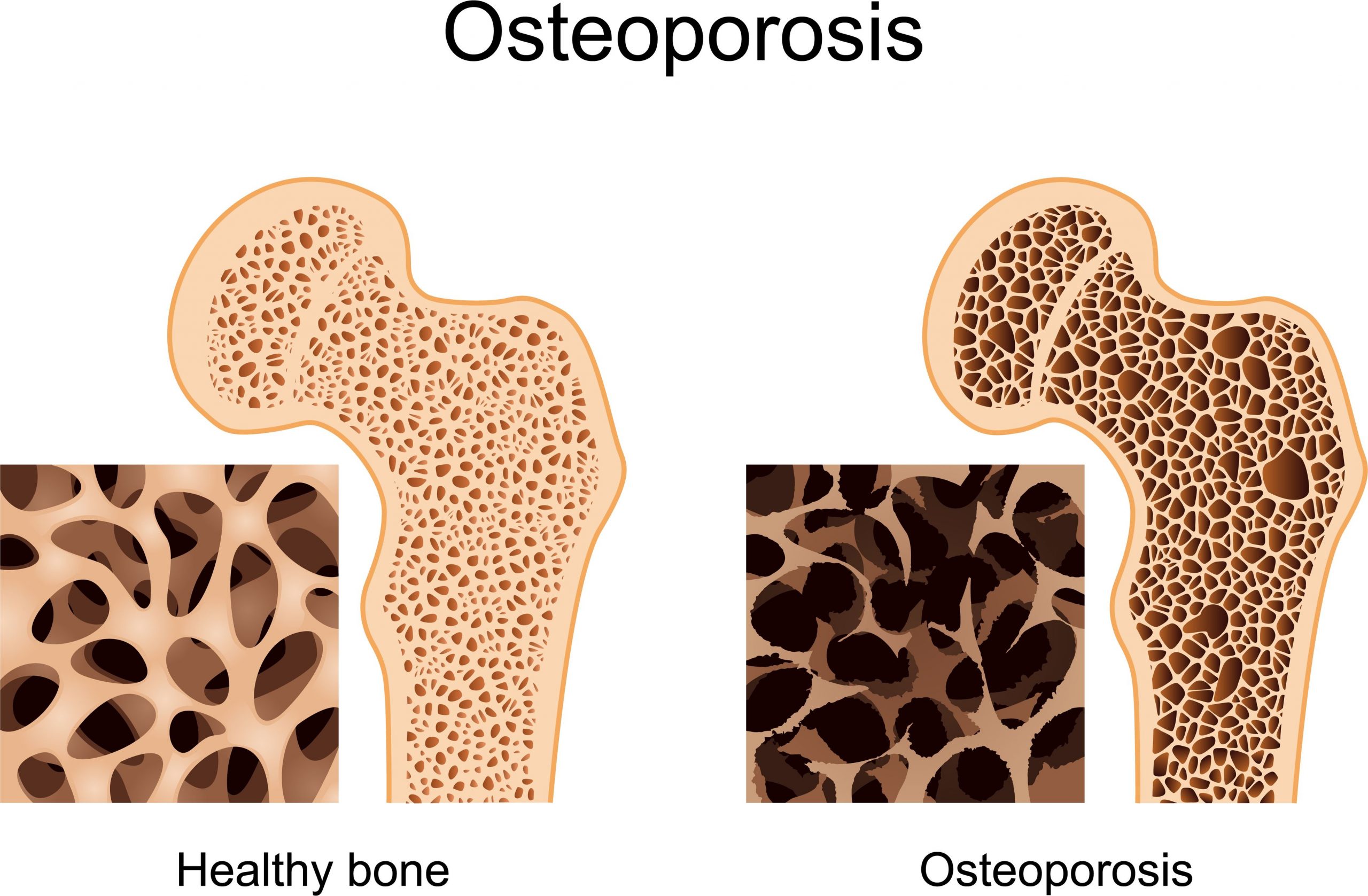 representación de l osteoporosis 