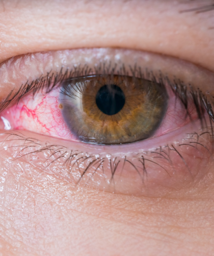 ojo rojo