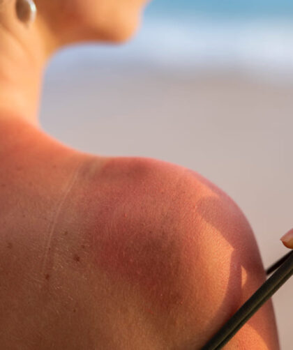 Piel quemada por el sol