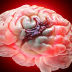 animación hemorragia cerebral