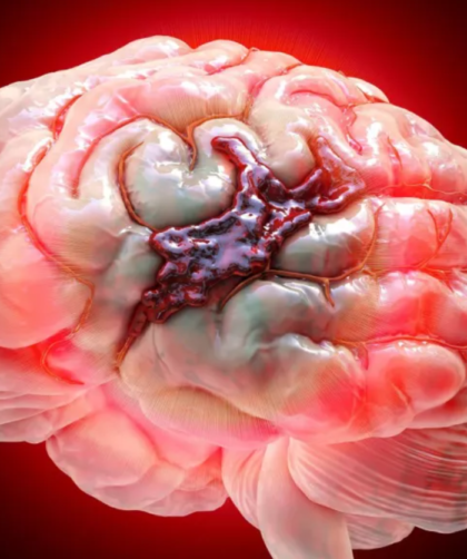 animación hemorragia cerebral